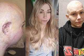 Mladou maminku v práci skalpoval stroj. Ani její děti ji nepoznávaly